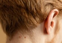 Удаляем дефекты: бородавки и методы их удаления